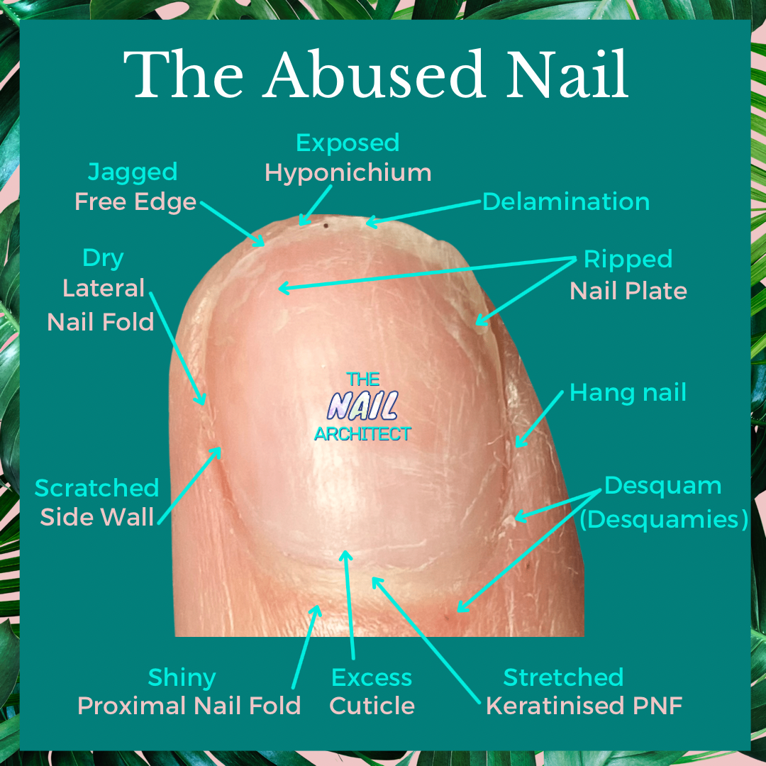 Nail Infection (Paronychia): What It Is, Symptoms, Causes, Treatment